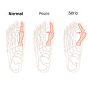 Corretor Ortopédico de Joanetes com Separador de Silicone + 12 PROTETORES DE DEDO EM SILICONE BÔNUS