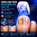 Ortho Vital – Dispositivo a Laser para Micose de Unha