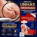 Adesivos Antifúngicos para Unhas – Tratamento Noturno Profundo