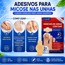 Adesivos Antifúngicos para Unhas – Tratamento Noturno Profundo