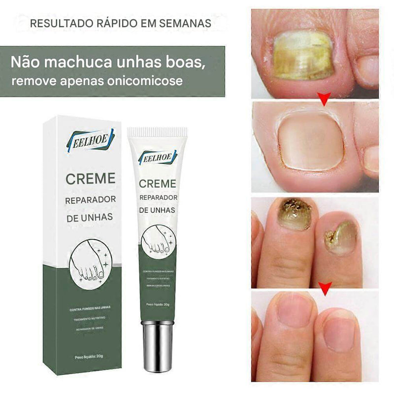Creme Antifúngico para Unhas Eelhoe – Restaura e Fortalece