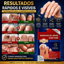 Adesivos Antifúngicos para Unhas – Tratamento Noturno Profundo